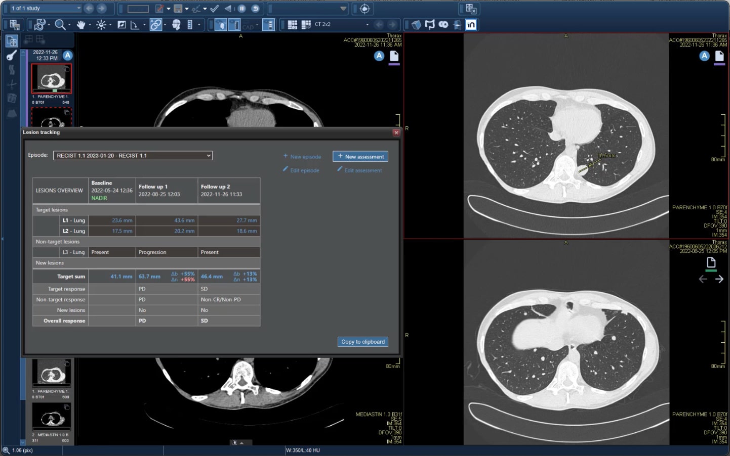 screen lesion Agfa Healthcare - Lesion Tracking